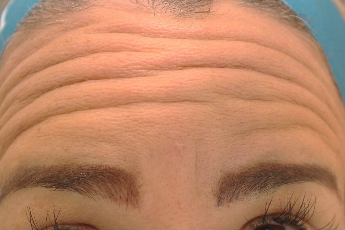 Botox(1)depois Botox (depois)