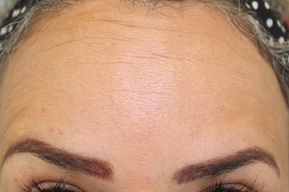 Botox(1)depois Botox (depois)