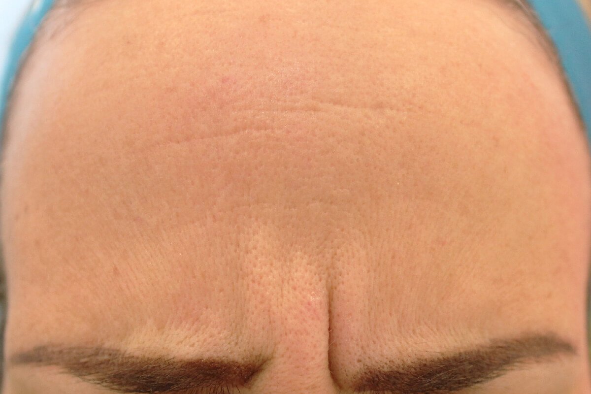 Botox(2)depois Ácido hialurónico (depois)