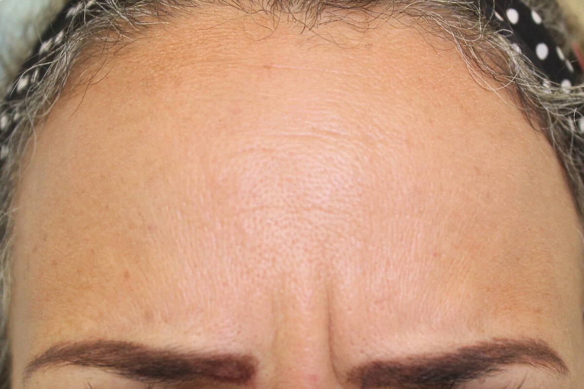 Botox(2)depois Ácido hialurónico (depois)