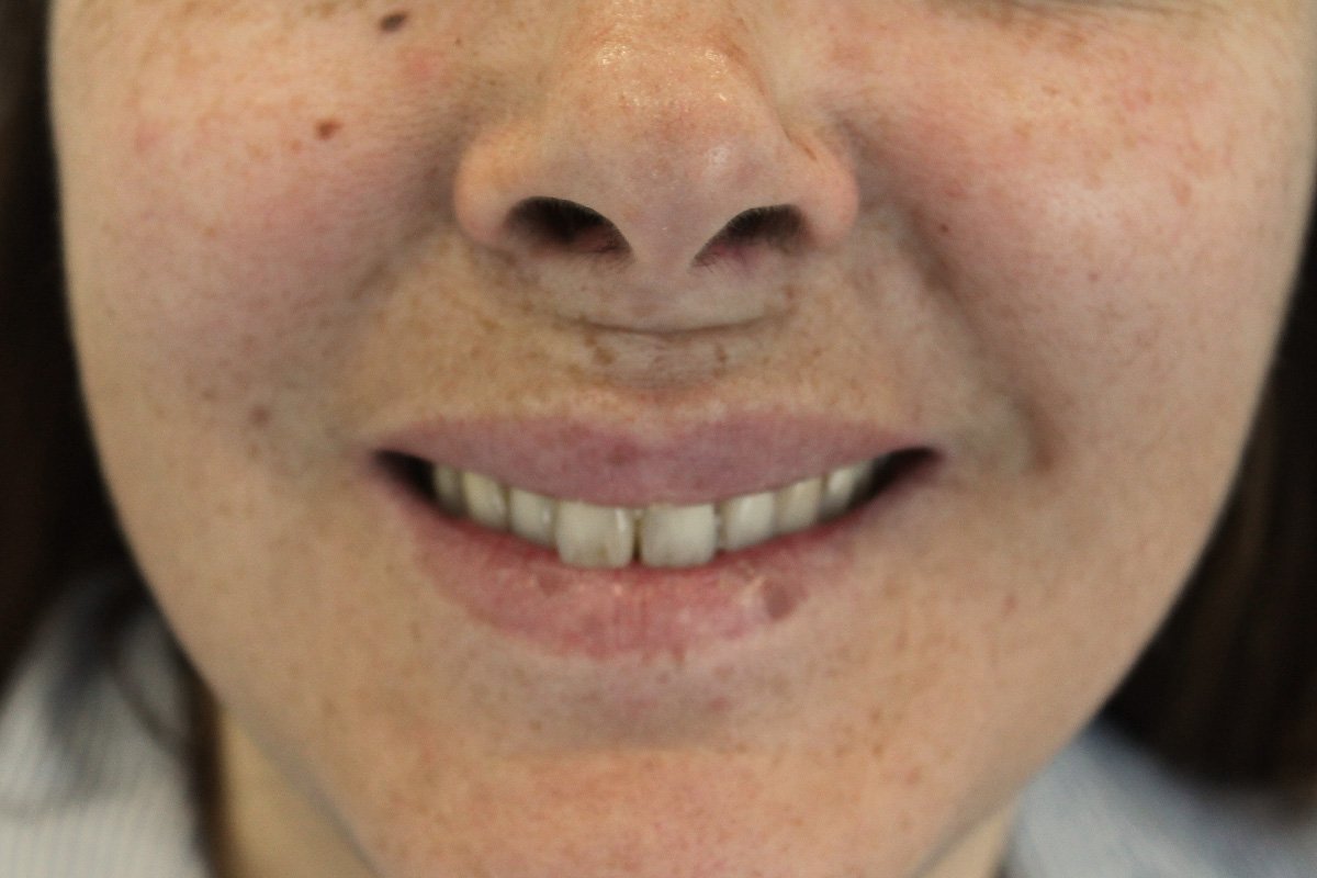 Botox(3)depois Botox (depois)