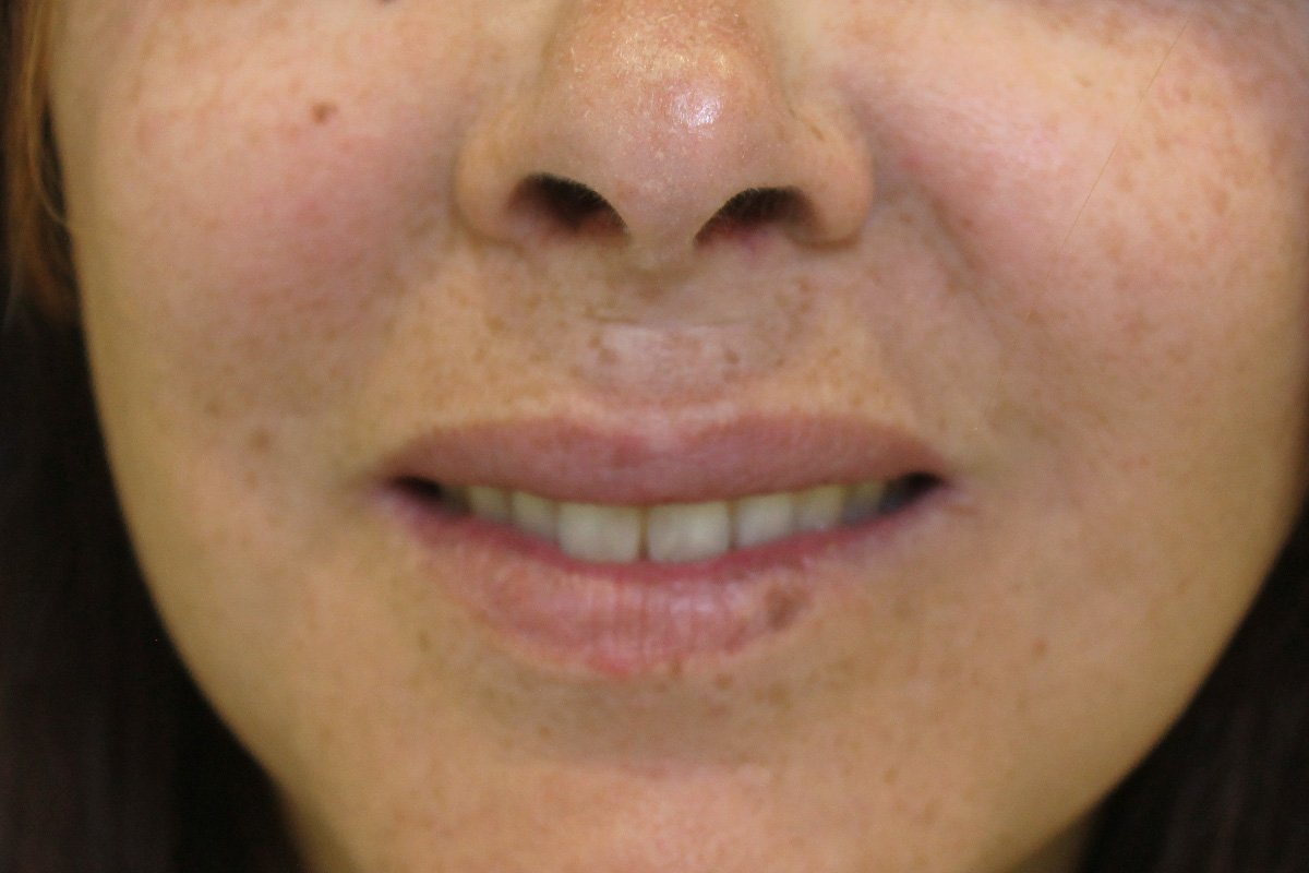 Botox(3)depois Botox (depois)