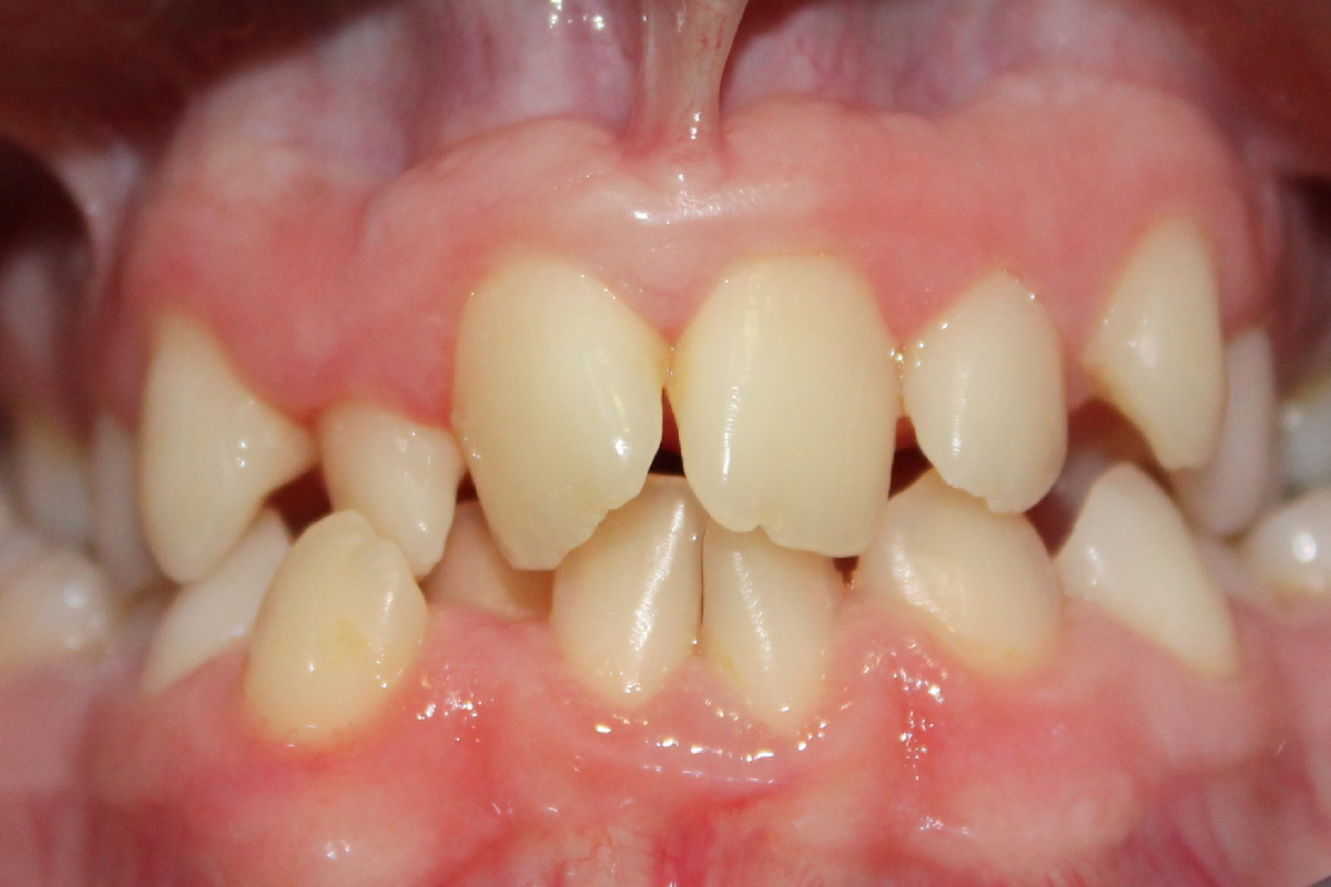 Ortodontia-depois