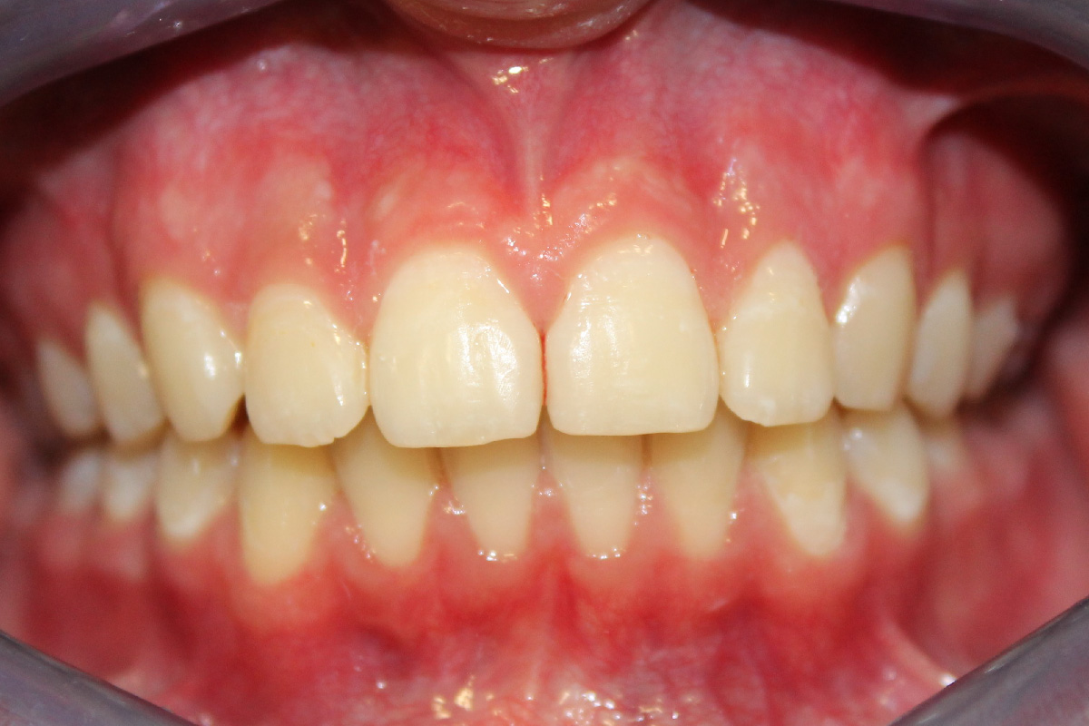 Ortodontia-depois