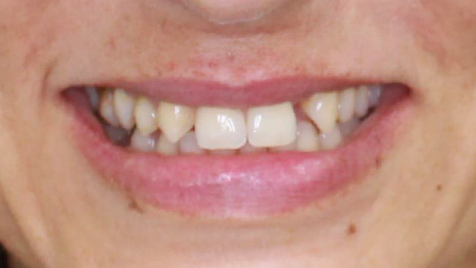 caso clinico invisalign 6