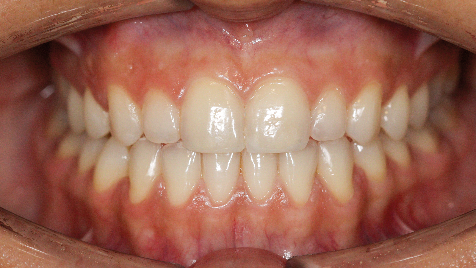caso clinico invisalign 6