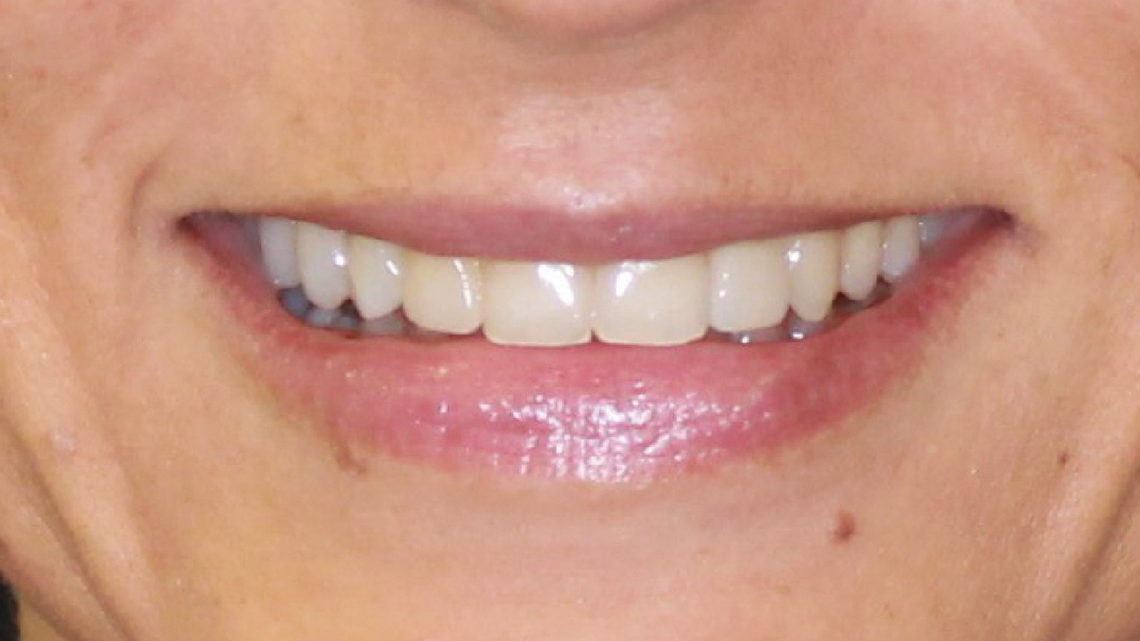 caso clinico invisalign 6