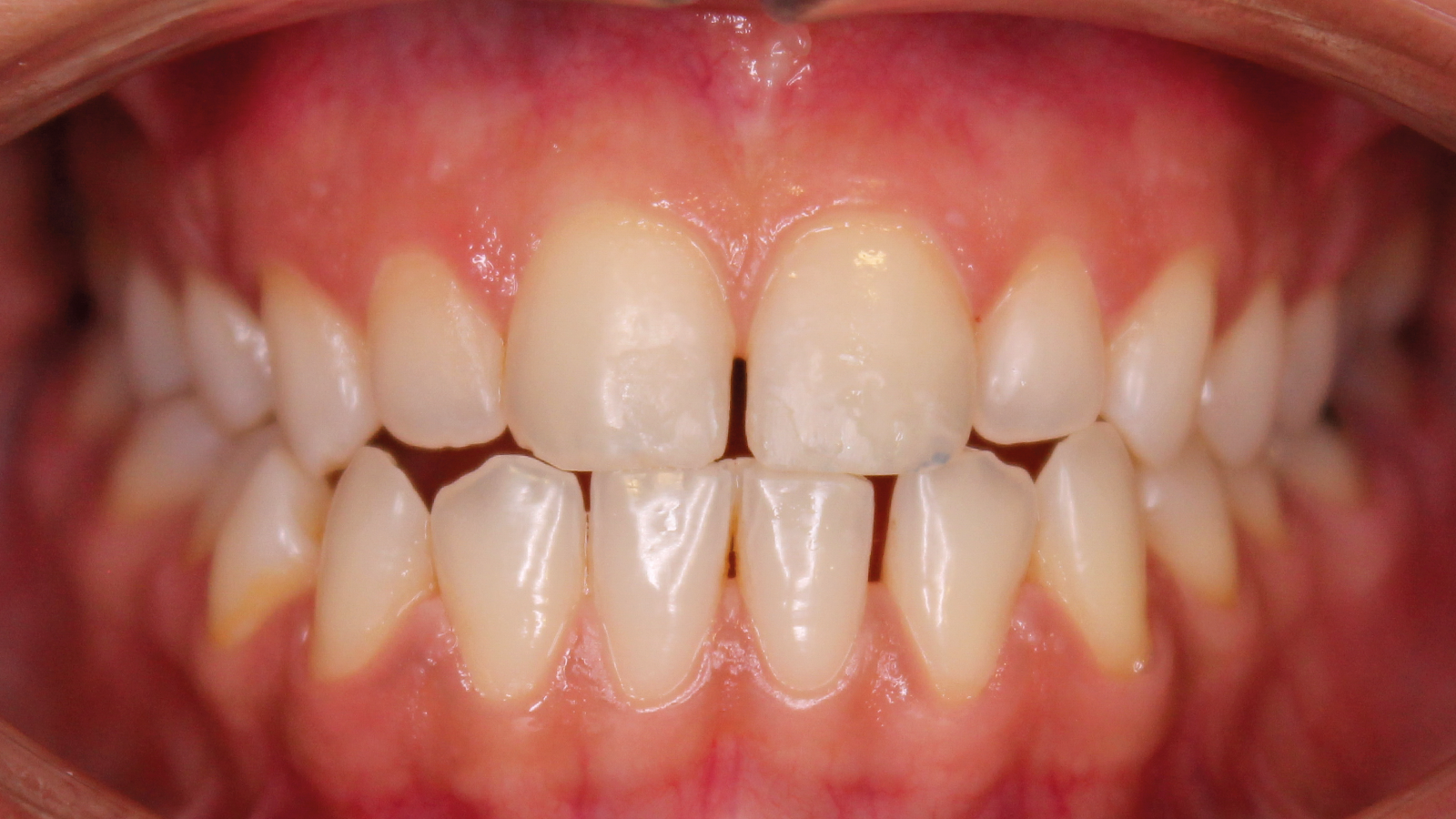 caso clinico invisalign 6