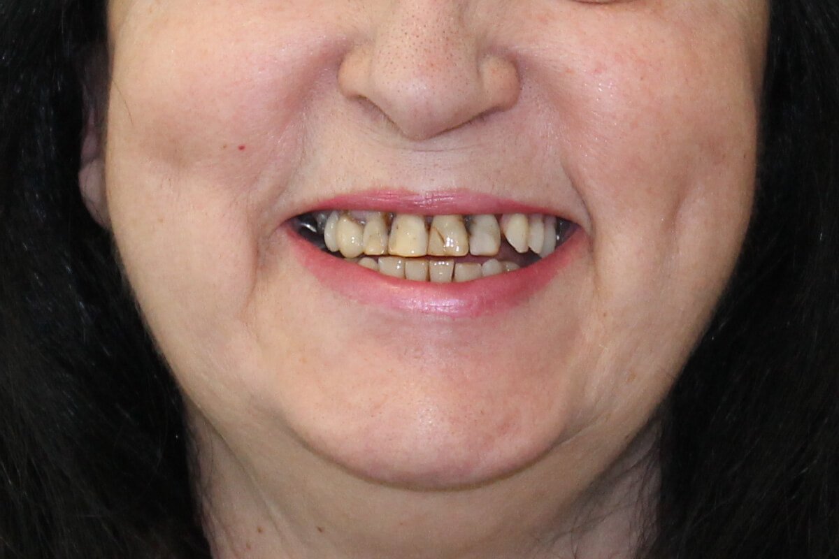 dentes_fixos_dia2depois