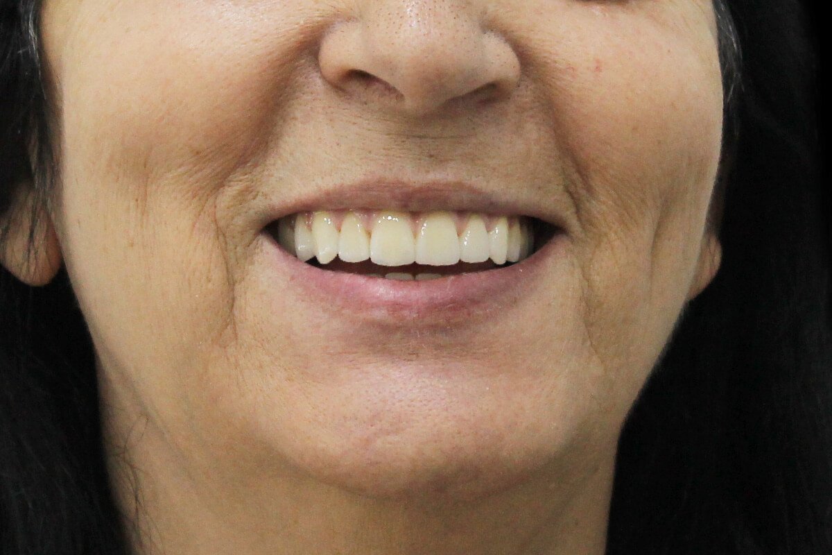 dentes_fixos_dia2depois